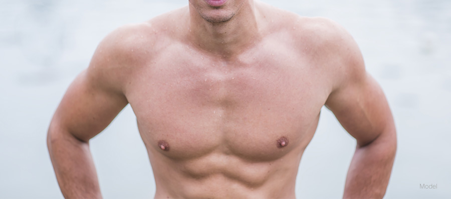 gynecomastia