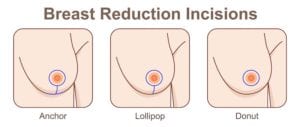 Which Breast Reduction Incision Type Is Right for Me?