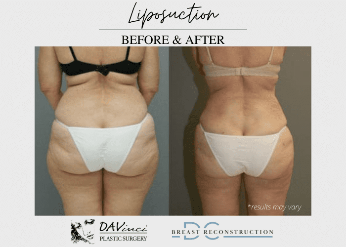 BRA STRAP lipo is the latest cosmetic treatment for women looking to banish  back fat in time for the beach