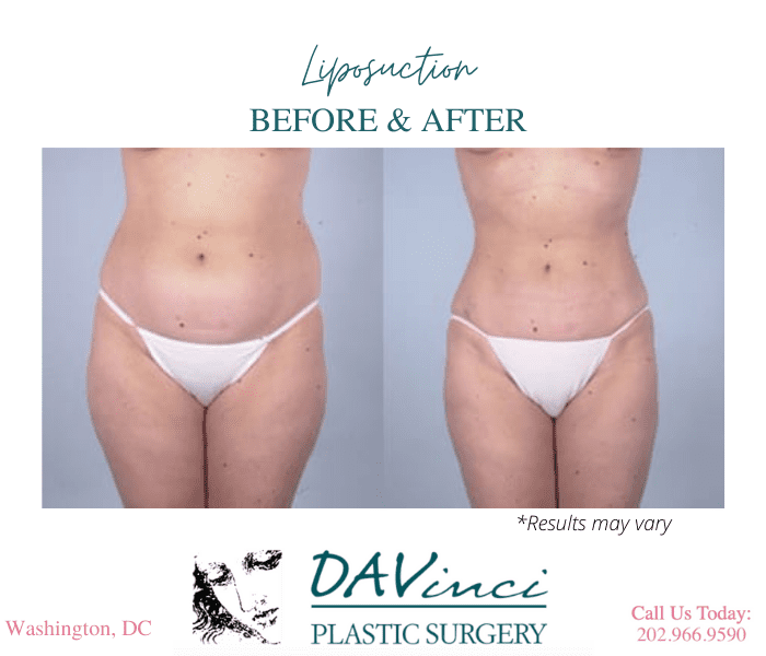 Can Liposuction Help Me Achieve a More Proportionate Body Shape?