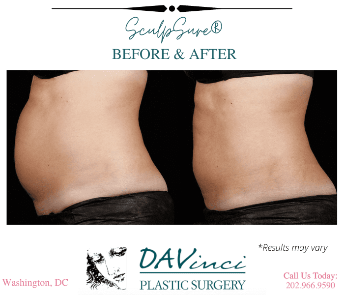 Does SculpSure® Give You the Same Results as Liposuction?
