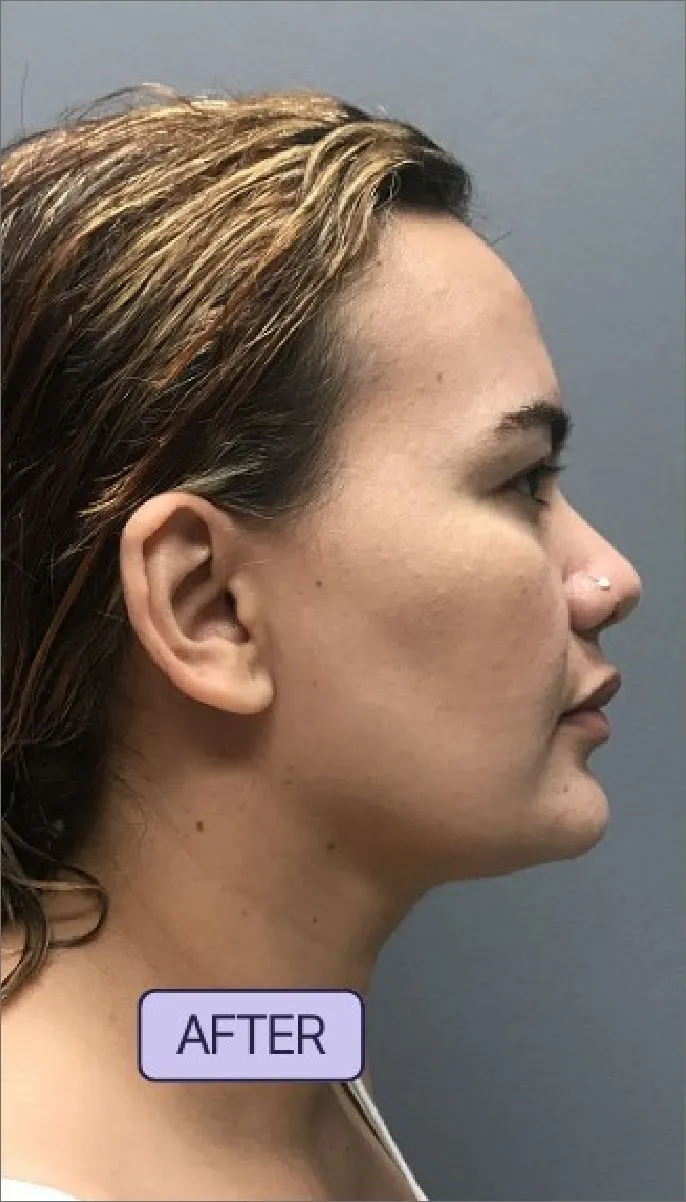 After Kybella Treatment by Nora, PA-C