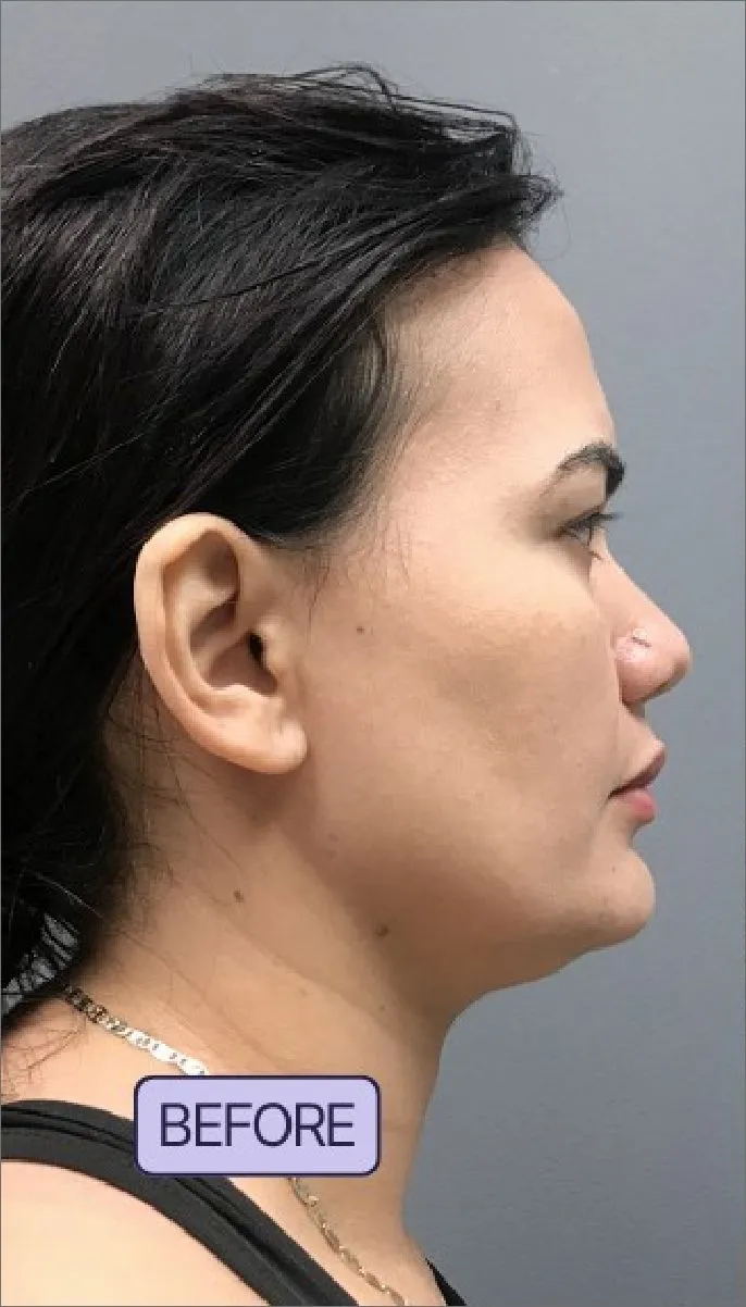 Before Kybella Treatment by Nora, PA-C