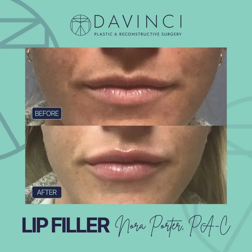 Davinci Plastic and Reconstructive Surgery - Lip Filler before and after